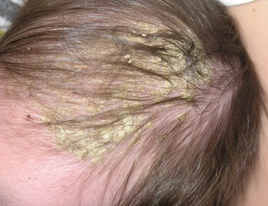 How to Banish Cradle Cap: Simple Tips for Soothing Baby's Scalp