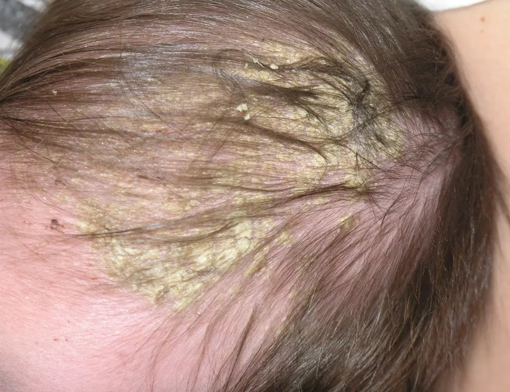 How to Banish Cradle Cap: Simple Tips for Soothing Baby's Scalp